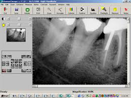 Dental Digital X-rays