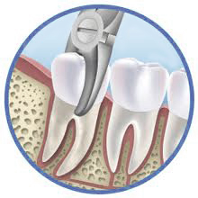 Tooth-Extraction-Tooth-Removal