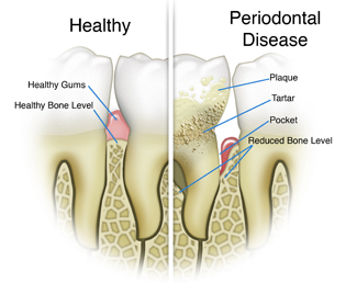 Dental Cleaning