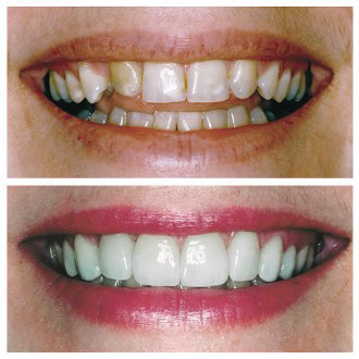 Smile makeovers deals
