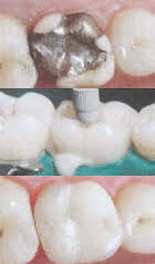 Tooth-colored-Fillings