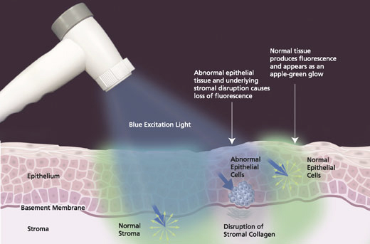 Velscope Oral Cancer Screening