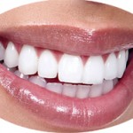 Teeth Whitening